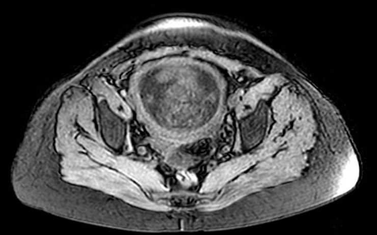 Colon adenocarcinoma with Krukenberg tumors, advanced pregnancy (Radiopaedia 67279-76645 A 17).jpg