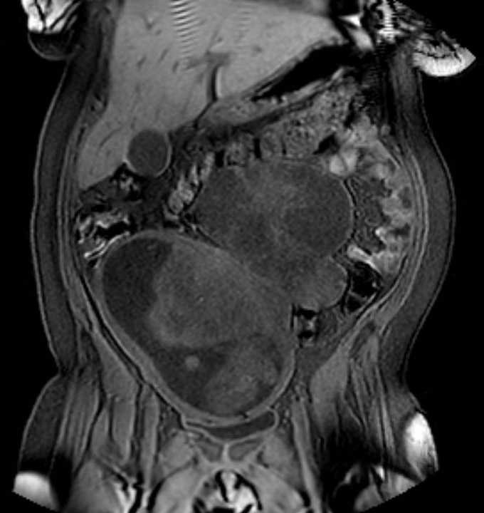 Colon adenocarcinoma with Krukenberg tumors, advanced pregnancy (Radiopaedia 67279-76645 E 29).jpg