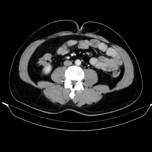 Colonic lipoma with colo-colic intussusception (Radiopaedia 58944-66200 A 36).jpg