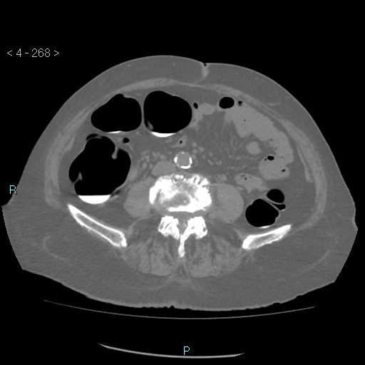 Colonic lipomas (Radiopaedia 49137-54244 Axial bone window 120).jpg