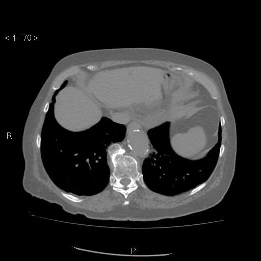Colonic lipomas (Radiopaedia 49137-54244 Axial bone window 32).jpg