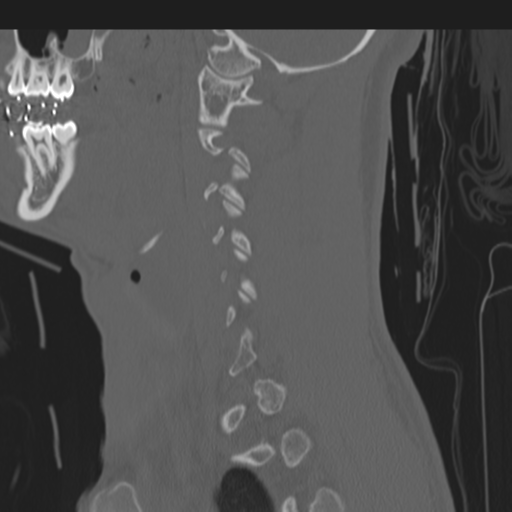 File:Multitrauma with diffuse axonal injury, temporal bone fractures and traumatic caroticocavernous fistula (Radiopaedia 37242-39035 Sagittal 33).png