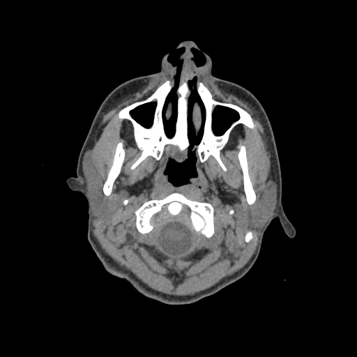 Nasal pyogenic granuloma (lobular capillary hemangioma) (Radiopaedia 85536-101244 Axial non-contrast 9).jpg