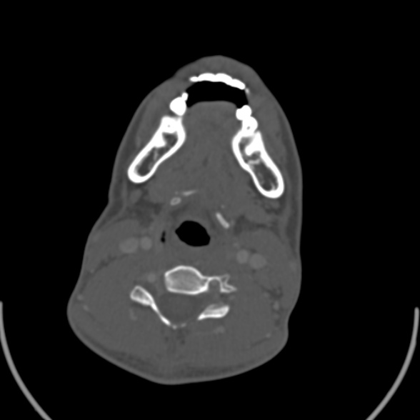 File:Nasopharyngeal carcinoma with skull base invasion (Radiopaedia 53415-59705 Axial bone window 128).jpg