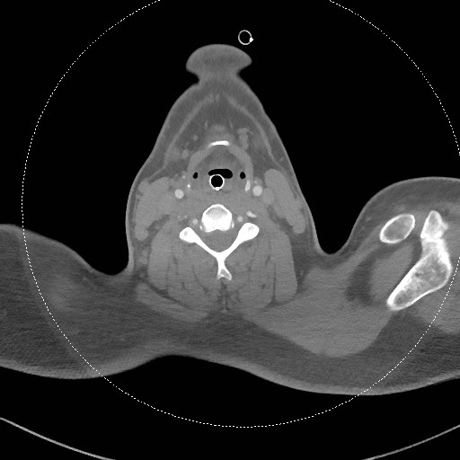 Neck CT angiogram (intraosseous vascular access) (Radiopaedia 55481-61945 B 172).jpg
