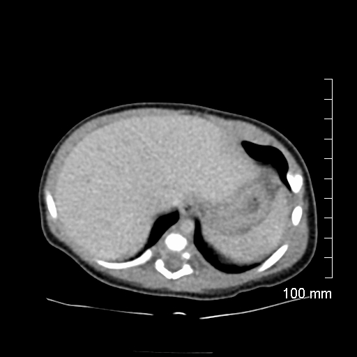 File:Neonatal neuroblastoma (Radiopaedia 56651-63438 Axial non-contrast 17).jpg