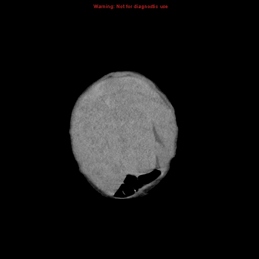 File:Neonatal neuroblastoma (Radiopaedia 9564-10223 B 15).jpg