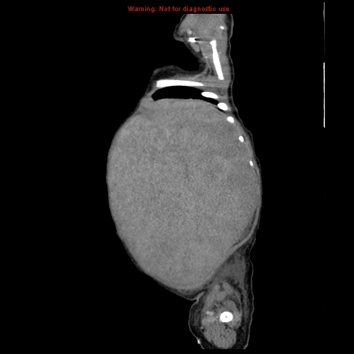 File:Neonatal neuroblastoma (Radiopaedia 9564-10223 C 27).jpg