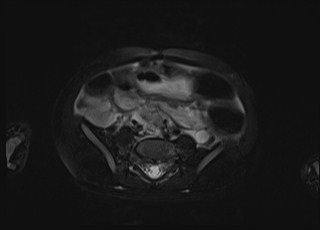 Neonatal prostatic utricle abscess - cyst (Radiopaedia 69511-79394 Axial T2 fat sat 34).jpg