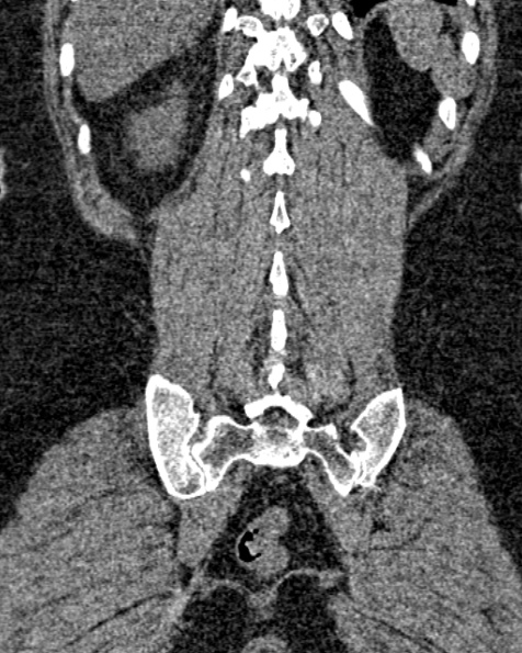 File:Nephrostomy for urosepsis (Radiopaedia 26180-26330 non-contrast 73).jpg