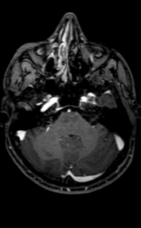 Neuro-Behçet disease (Radiopaedia 90112-107294 Axial T1 C+ 171).jpg