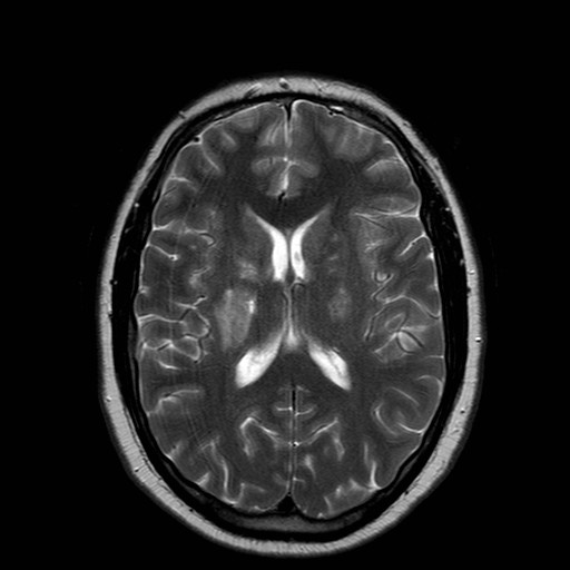 File:Neuro-Behcet's disease (Radiopaedia 21557-21505 Axial T2 13).jpg