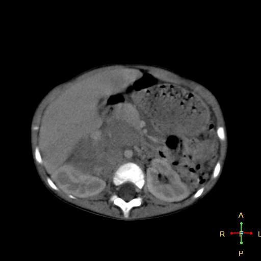 File:Neuroblastoma (Radiopaedia 24751-25016 D 17).jpg