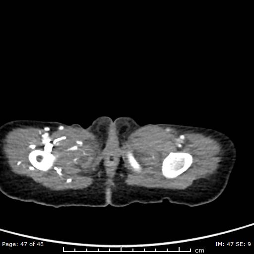 File:Neuroblastoma (Radiopaedia 41472-44355 A 47).jpg