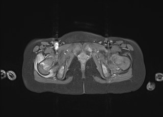 File:Neuroblastoma with bone metastases (Radiopaedia 67080-76414 Axial T1 C+ fat sat 45).jpg