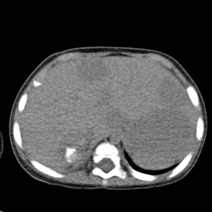 Neuroblastoma with skull metastases (Radiopaedia 30326-30960 Axial non-contrast 10).jpg