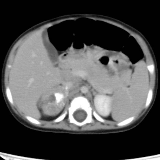 Neuroblastoma with skull metastases (Radiopaedia 30326-30960 C 18).jpg