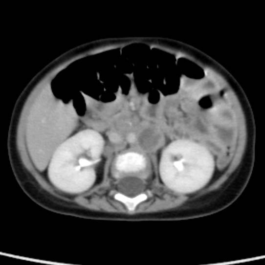 Neuroblastoma with skull metastases (Radiopaedia 30326-30960 C 30).jpg