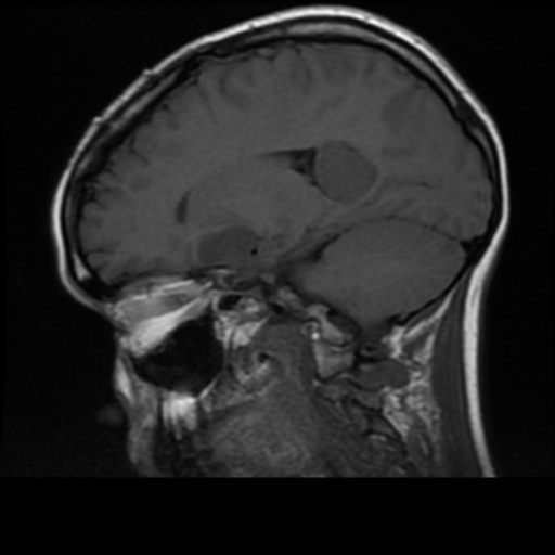 File:Neurofibromatosis type 2 (Radiopaedia 45229-49244 Sagittal T1 8).png