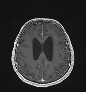 Neurofibromatosis type 2 (Radiopaedia 79097-92049 Axial T1 C+ 136).jpg