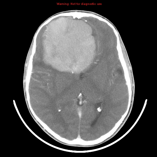 File:Neurofibromatosis type 2 (Radiopaedia 8953-9732 C 18).jpg