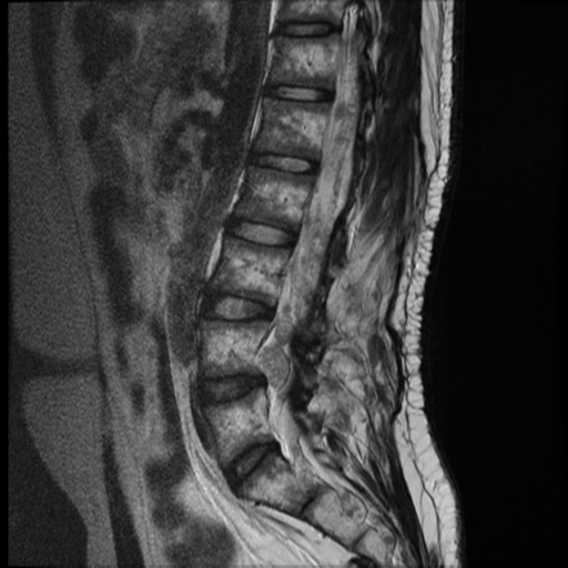 File:Neurofibromatosis type 2 (spinal manifestations) (Radiopaedia 53943-60070 E 6).png