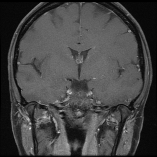 File:Neurofibromatosis type 2 - bilateral acoustic neuromata (Radiopaedia 40060-42566 Coronal T1 C+ 9).png