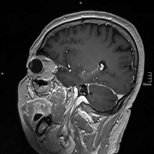 Neurosarcoidosis - involvement of the mesial temporal lobes (Radiopaedia 67429-76820 Sagittal T1 C+ 116).jpg