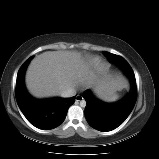 File:Non-Hodgkin lymphoma involving pelvis (Radiopaedia 21281-21197 A 7).jpg