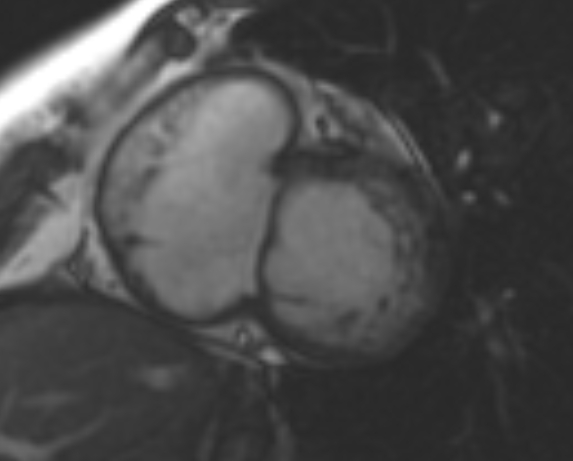 File:Non-compaction of the left ventricle (Radiopaedia 69436-79314 Short axis cine 162).jpg