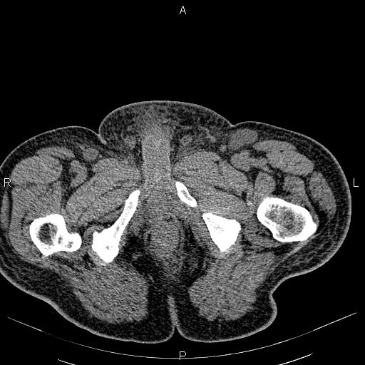 File:Non Hodgkin lymphoma in a patient with ankylosing spondylitis (Radiopaedia 84323-99621 Axial non-contrast 66).jpg