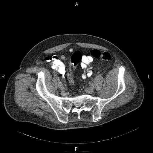 File:Non Hodgkin lymphoma in a patient with ankylosing spondylitis (Radiopaedia 84323-99624 Axial non-contrast 55).jpg