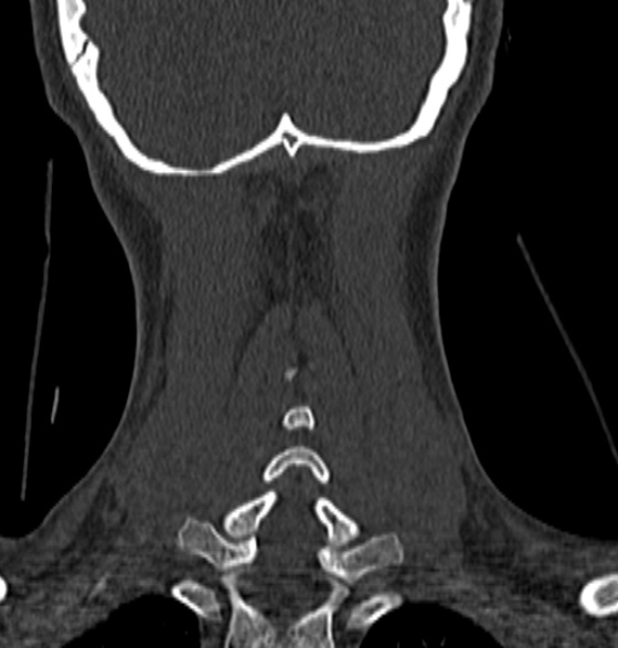 File:Normal CT cervical spine - 12-year-old (Radiopaedia 55352-61775 Coronal bone window 185).jpg