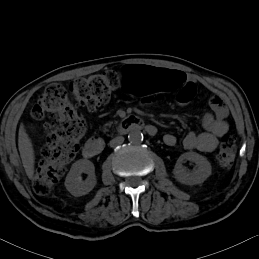File:Normal CT intravenous cholangiogram (Radiopaedia 38199-40208 Axial IVC 54).png