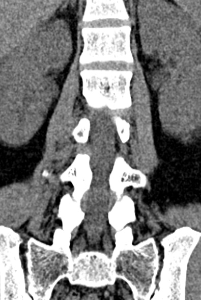Normal CT lumbar spine (Radiopaedia 53981-60118 F 49).jpg
