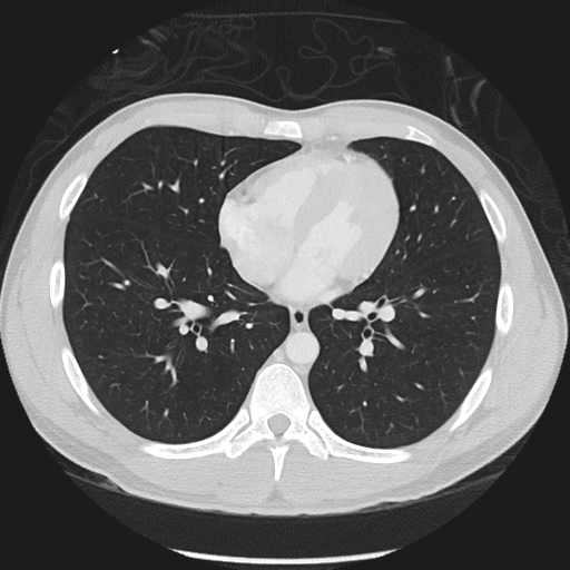 Normal CT pulmonary veins (pre RF ablation) (Radiopaedia 41748-44702 Axial lung window 35).png