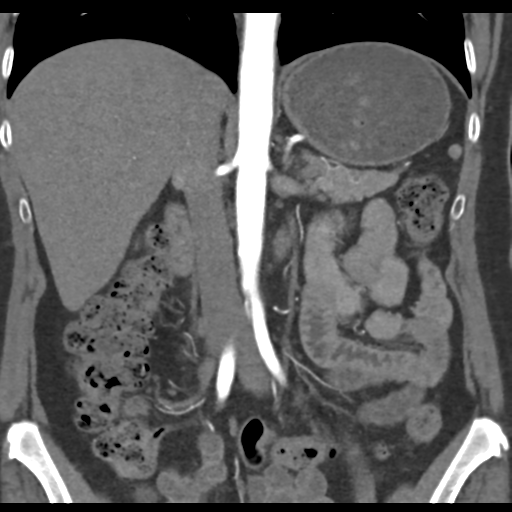 File:Normal CT renal artery angiogram (Radiopaedia 38727-40889 B 40).png