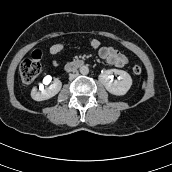 File:Normal CT split bolus study of the renal tract (Radiopaedia 48631-53634 Axial split bolus 118).jpg