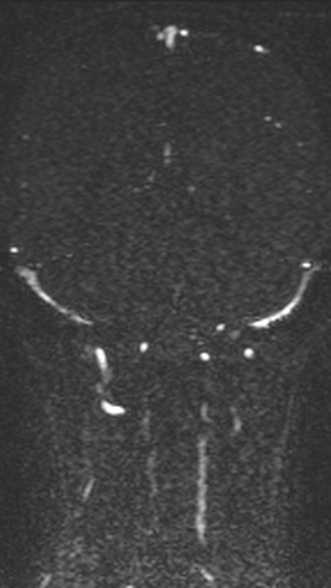 Normal MRI brain with MRV- teenager (Radiopaedia 49425-54553 Coronal MRV 166).jpg