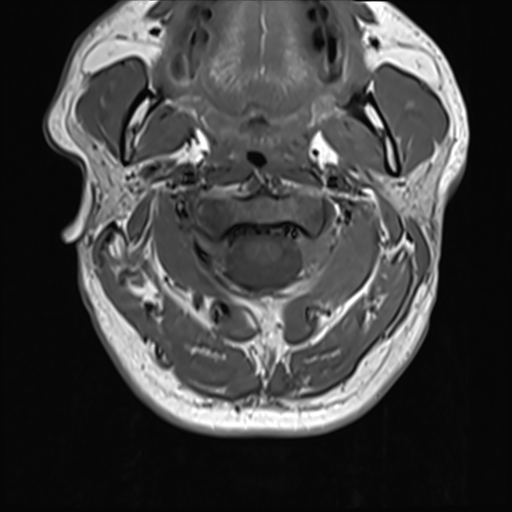 File:Normal MRI cervical spine (infection protocol) (Radiopaedia 53916-60039 Axial 12).png