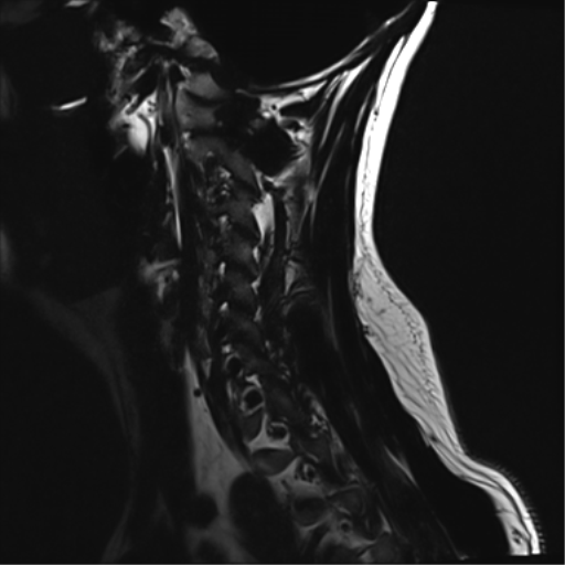 File:Normal MRI cervical spine (infection protocol) (Radiopaedia 53916-60039 F 15).png