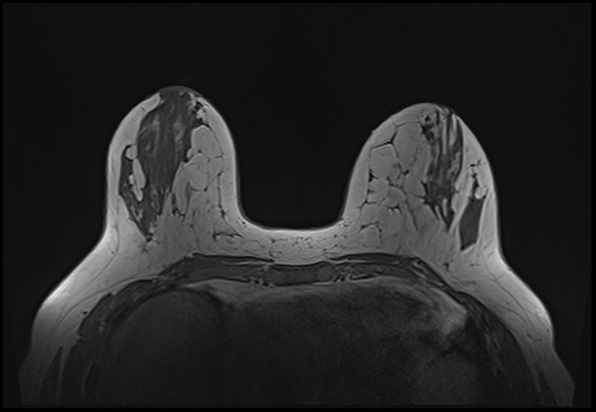 File:Normal breast MRI - dense breasts (Radiopaedia 80454-93850 Axial T1 78).jpg