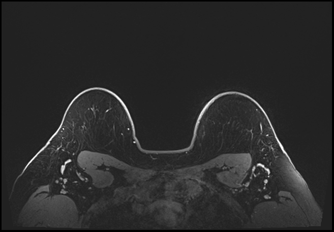 Normal breast MRI - dense breasts (Radiopaedia 80454-93850 C 194).jpg