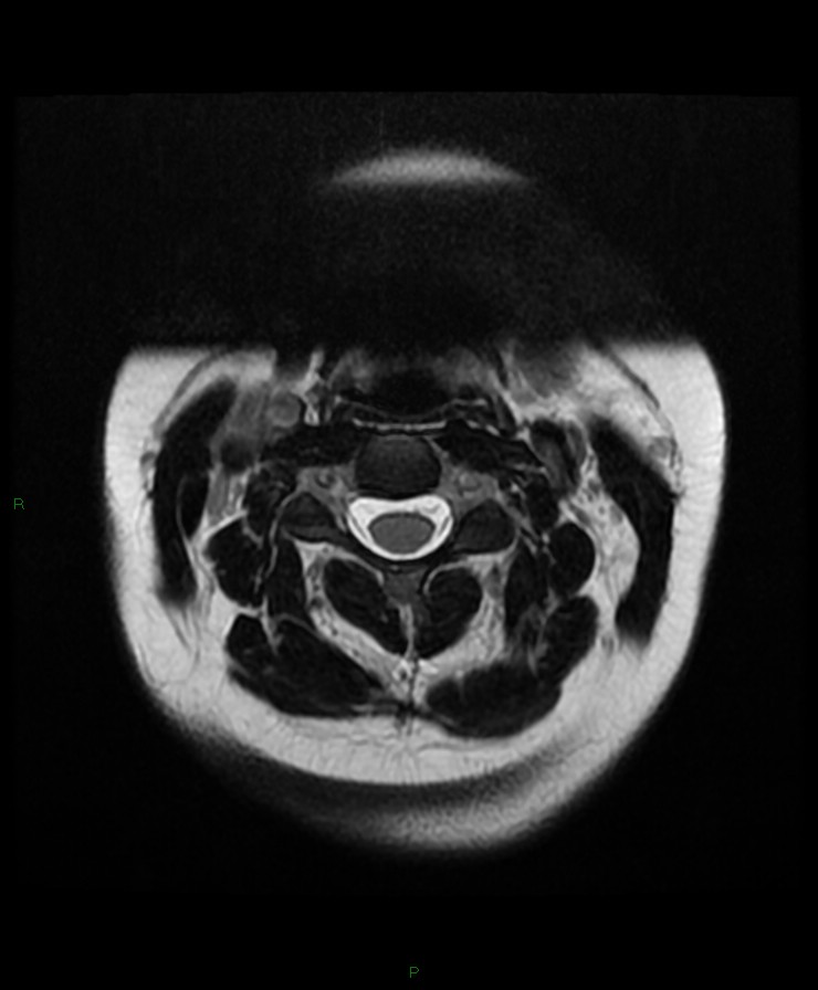 Normal cervical spine MRI (Radiopaedia 80146-93454 Axial T2 26).jpg