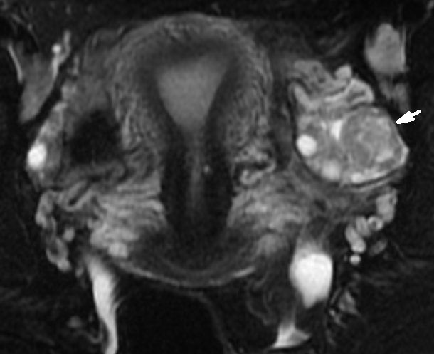 File:Normal corpus luteum on MRI (Radiopaedia 13818-13696 Coronal STIR 1).jpg