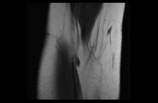 File:Normal elbow arthrograms (Radiopaedia 75550-86805 Coronal T1 18).jpg