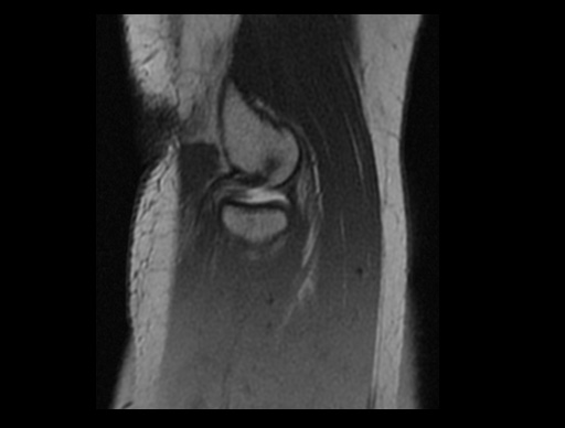 File:Normal elbow arthrograms (Radiopaedia 75550-86805 Sagittal PD 12).jpg