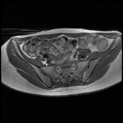 File:Normal female pelvis MRI (retroverted uterus) (Radiopaedia 61832-69933 Axial T1 9).jpg
