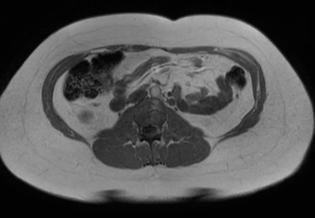 File:Normal liver MRI with Gadolinium (Radiopaedia 58913-66163 Axial T1 in-phase 6).jpg