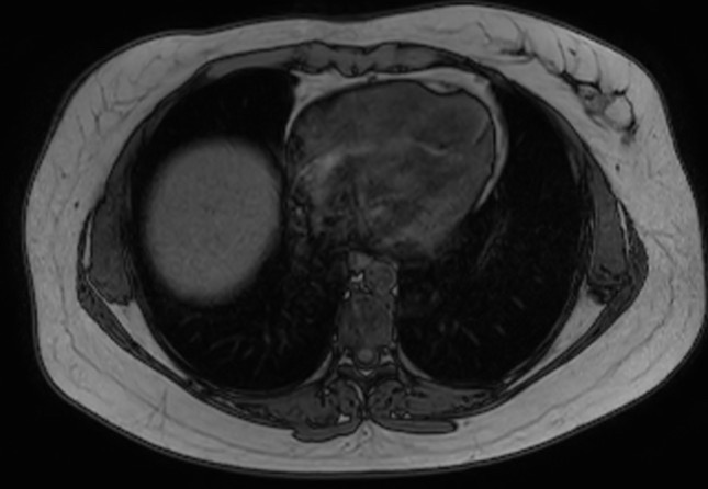 File:Normal liver MRI with Gadolinium (Radiopaedia 58913-66163 B 31).jpg